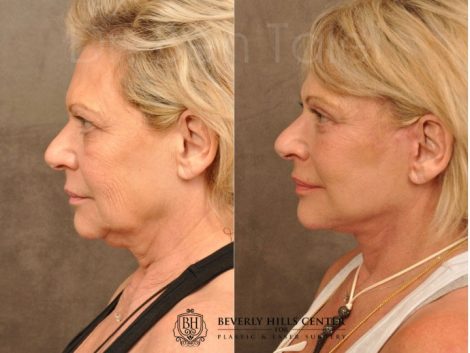 AuraLyft, Browlift, Upper & Lower Eyelid Rejuvenation