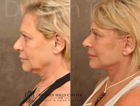AuraLyft, Browlift, Upper & Lower Eyelid Rejuvenation - Left Side