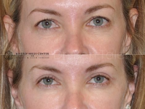Upper Eyelid Lift - Front