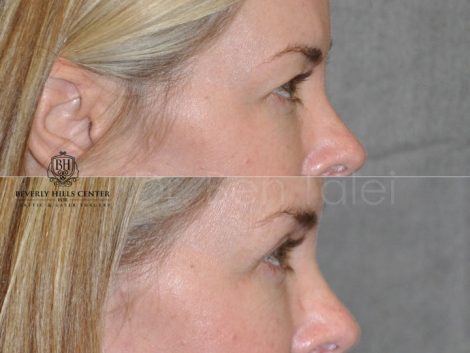 Upper Eyelid Lift - Right Side