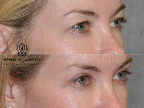 Upper Eyelid Lift - Right Side
