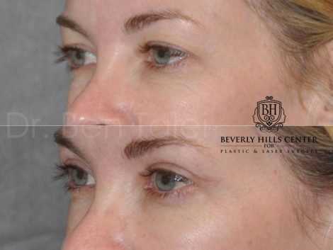 Upper Eyelid Lift - Left Side