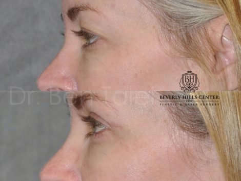 Upper Eyelid Lift - Left Side