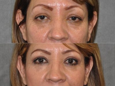 Upper & Lower Eyelid Rejuvenation - Front