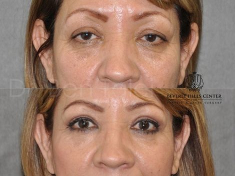 Upper & Lower Eyelid Rejuvenation - Front