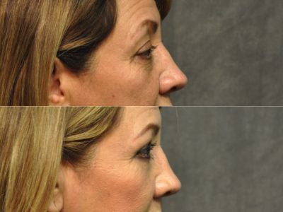 Upper & Lower Eyelid Rejuvenation - Right Side