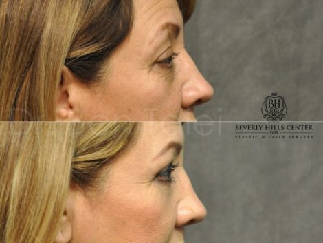 Upper & Lower Eyelid Rejuvenation - Right Side