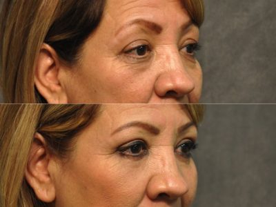 Upper & Lower Eyelid Rejuvenation - Right Side