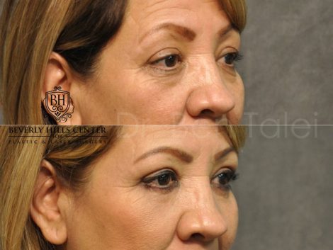 Upper & Lower Eyelid Rejuvenation - Right Side