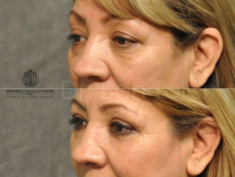 Upper & Lower Eyelid Rejuvenation - Left Side