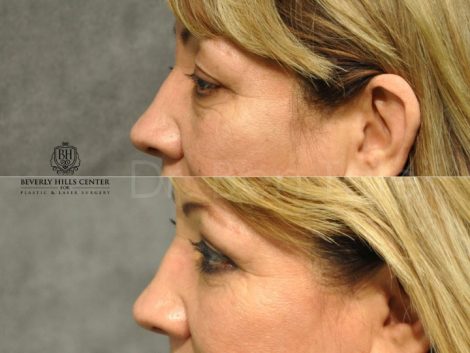 Upper & Lower Eyelid Rejuvenation - Left Side