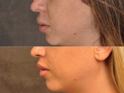 Modified Upper Lip Lift – Left Side
