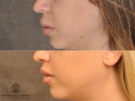 Modified Upper Lip Lift - Left Side