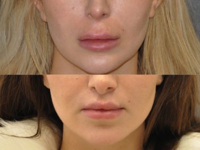 Modified Upper Lip Lift – Front