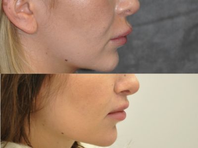 Modified Upper Lip Lift – Right SideModified Upper Lip Lift – Right Side