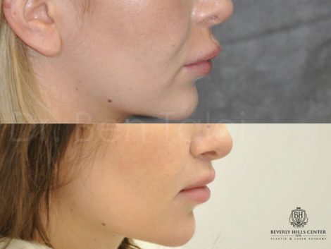 Modified Upper Lip Lift - Right Side