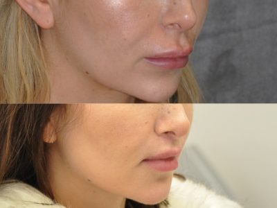 Modified Upper Lip Lift – Right Side