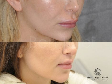 Modified Upper Lip Lift - Right Side