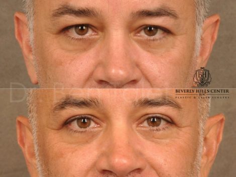 Upper Eyelid Lift - Front