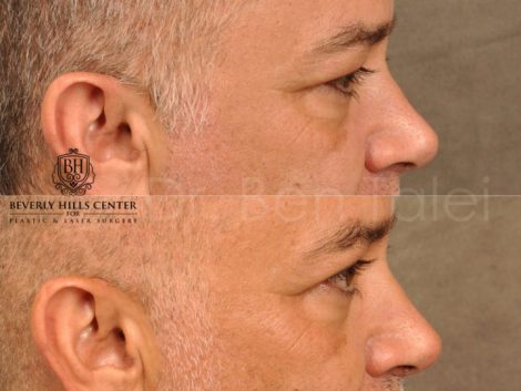 Upper Eyelid Lift - Right Side