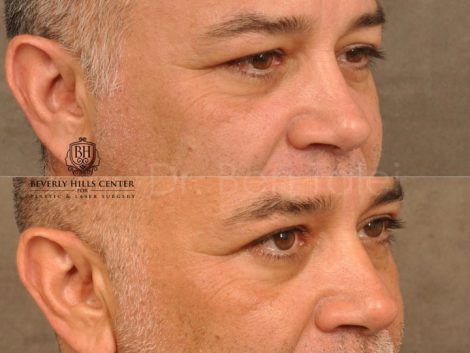Upper Eyelid Lift - Right Side