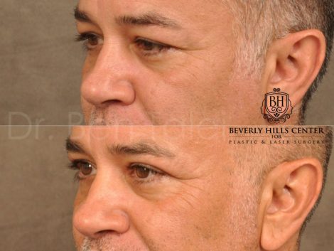 Upper Eyelid Lift - Left Side