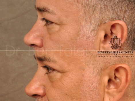 Upper Eyelid Lift - Left Side