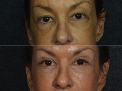 Upper and Lower Eyelid Rejuvenation - Front