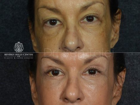 Upper and Lower Eyelid Rejuvenation - Front