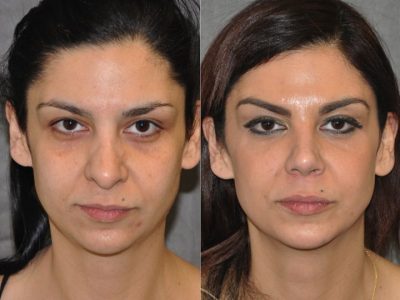 Cheek and Eye Enhancement - Front
