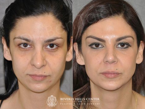 Cheek and Eye Enhancement - Front