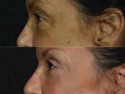 Upper and Lower Eyelid Rejuvenation - Left Side