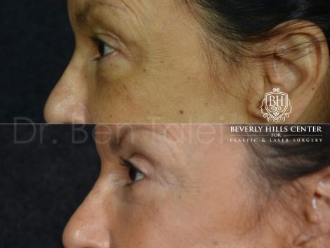 Upper and Lower Eyelid Rejuvenation - Left Side