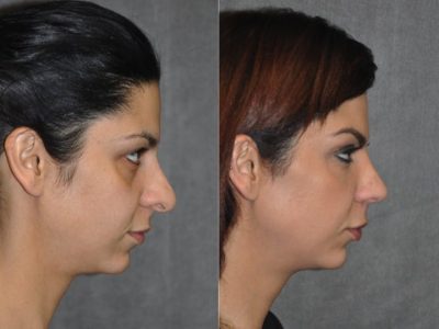 Cheek and Eye Enhancement - Right Side