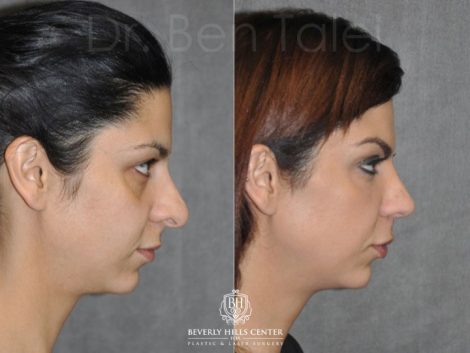 Cheek and Eye Enhancement - Right Side