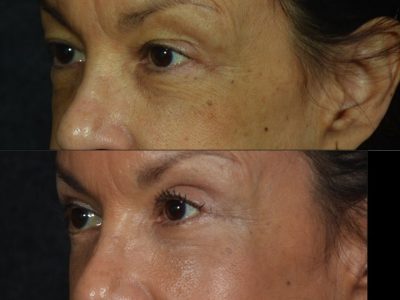 Upper and Lower Eyelid Rejuvenation - Left Side