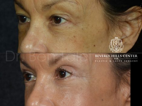 Upper and Lower Eyelid Rejuvenation - Left Side