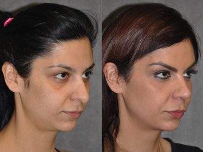 Cheek and Eye Enhancement - Right Side