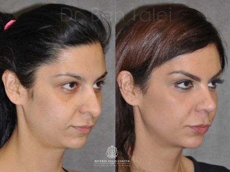 Cheek and Eye Enhancement - Right Side