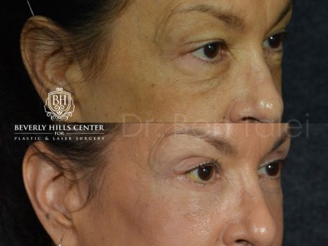 Upper and Lower Eyelid Rejuvenation - Right Side