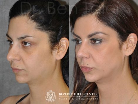 Beverly Hills Center Female Patient Before and After Revision Rhinoplasty ad Cheek and Eye Enhancement Procedure