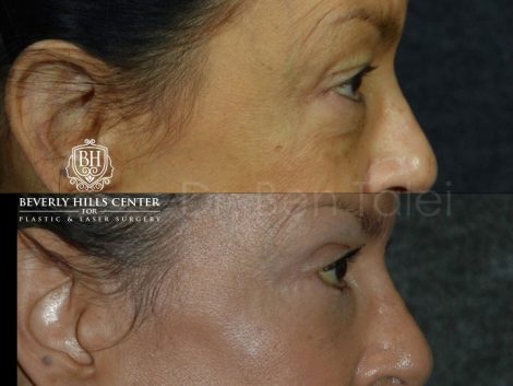 Upper and Lower Eyelid Rejuvenation - Right Side
