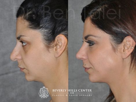 Beverly Hills Center Female Patient Before and After Revision Rhinoplasty ad Cheek and Eye Enhancement Procedure