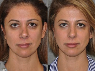 3rd Revision Rhinoplasty - Front