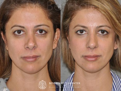 3rd Revision Rhinoplasty - Front