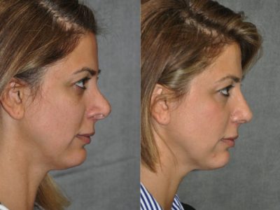 3rd Revision Rhinoplasty - Right Side