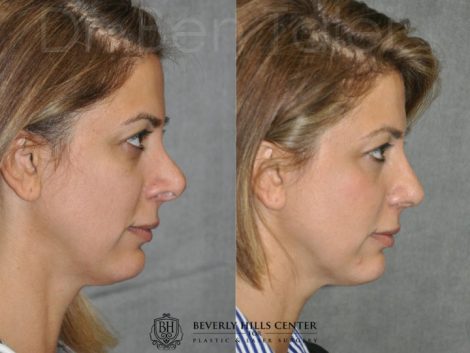 3rd Revision Rhinoplasty - Right Side