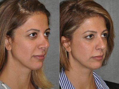 3rd Revision Rhinoplasty - Right Side