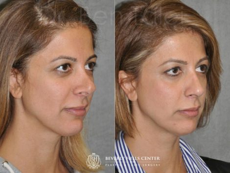 3rd Revision Rhinoplasty - Right Side