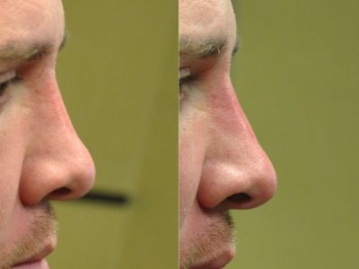 Non Surgical Nosejob